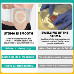 JFHNMLW ostomy belt provides breathable, long-term wear for comfort