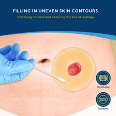 KONWEDA moldable barrier ring on stoma illustrating contouring