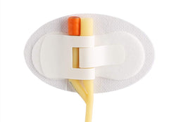 plceo statlock stabilization device keeps catheter in place safely.