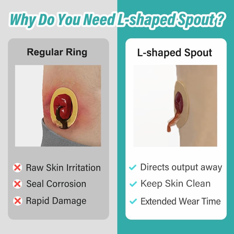 Giiiiump ostomy ring shows L-shaped groove for a secure, personalized fit.