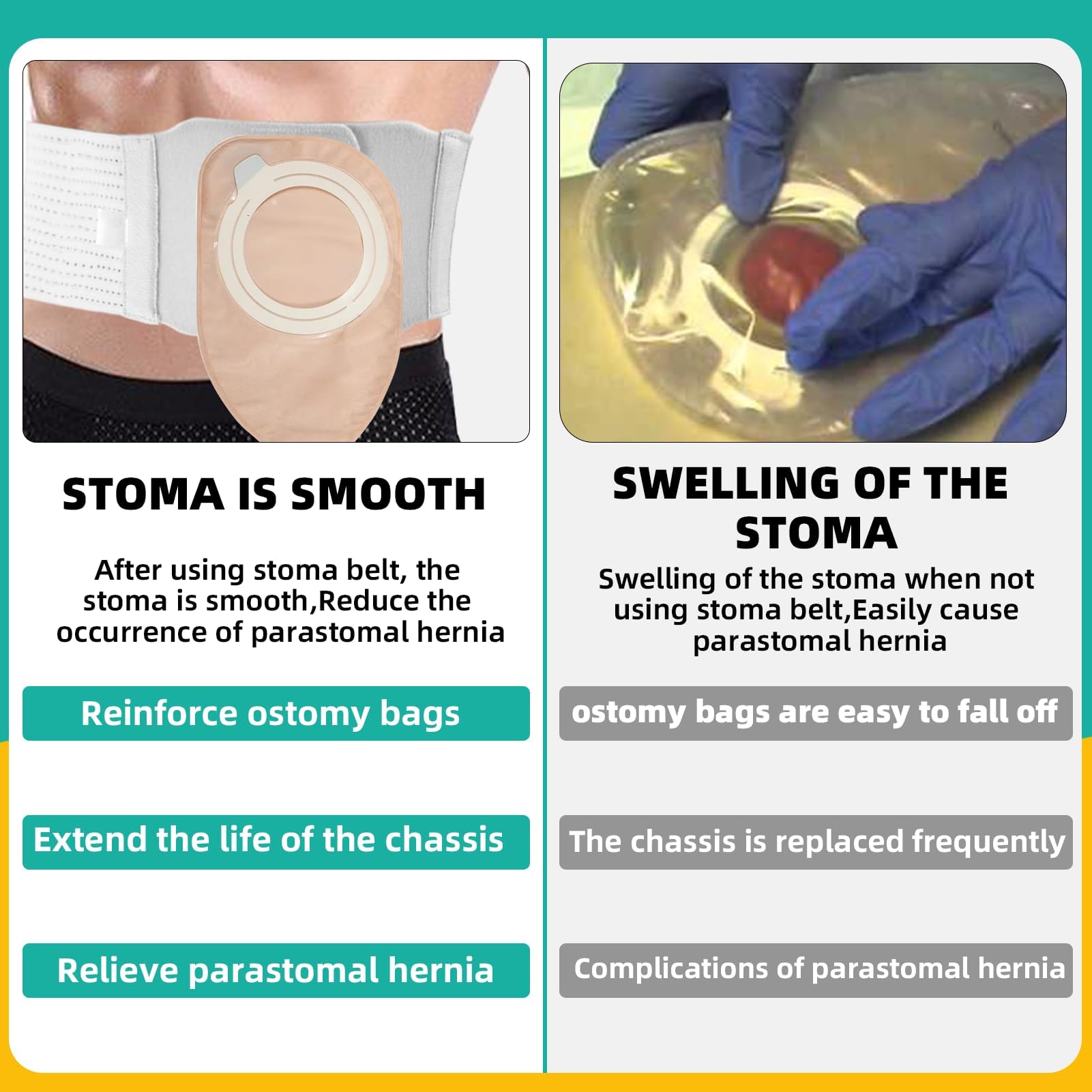 JFHNMLW ostomy belt provides breathable, long-term wear for comfort