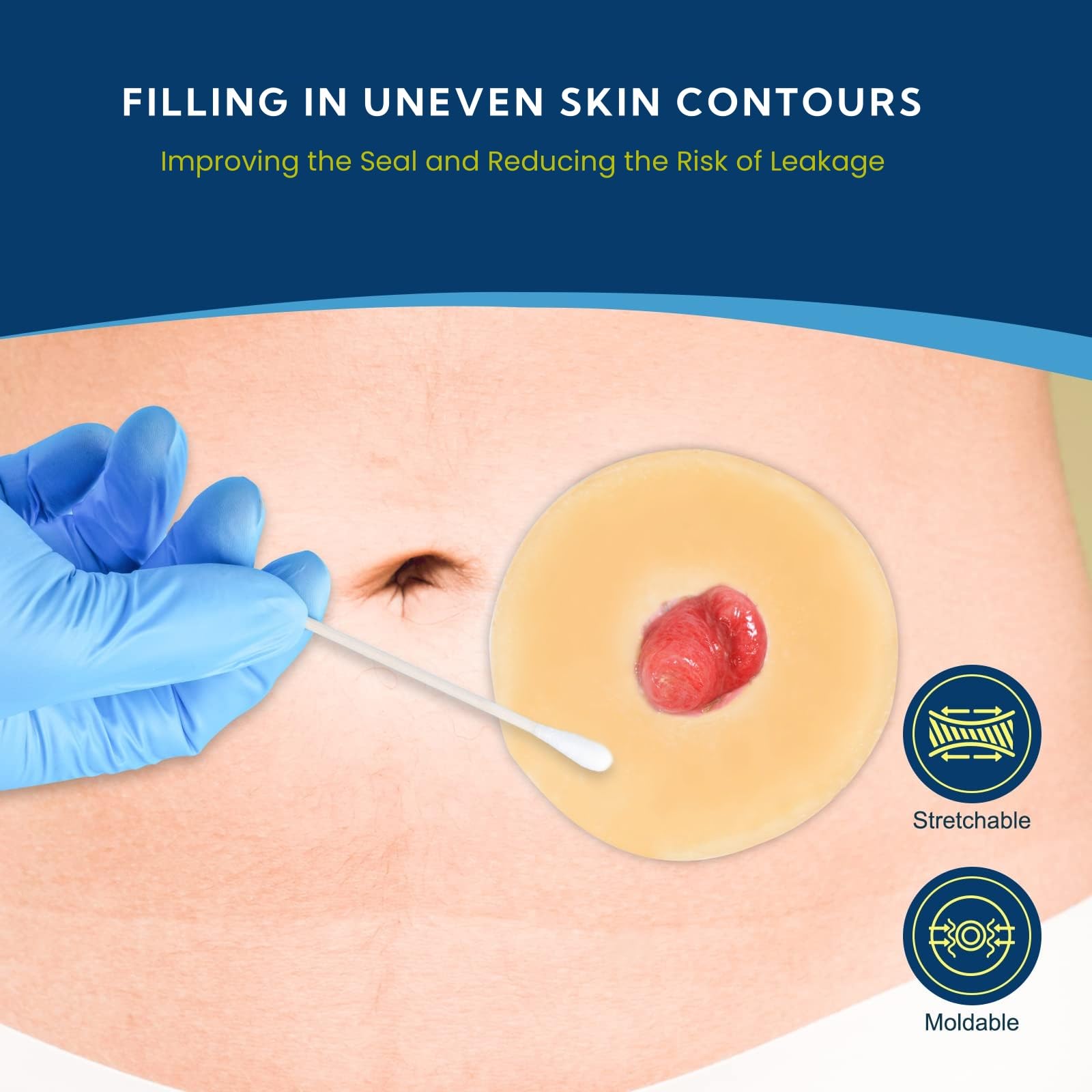 KONWEDA moldable barrier ring on stoma illustrating contouring