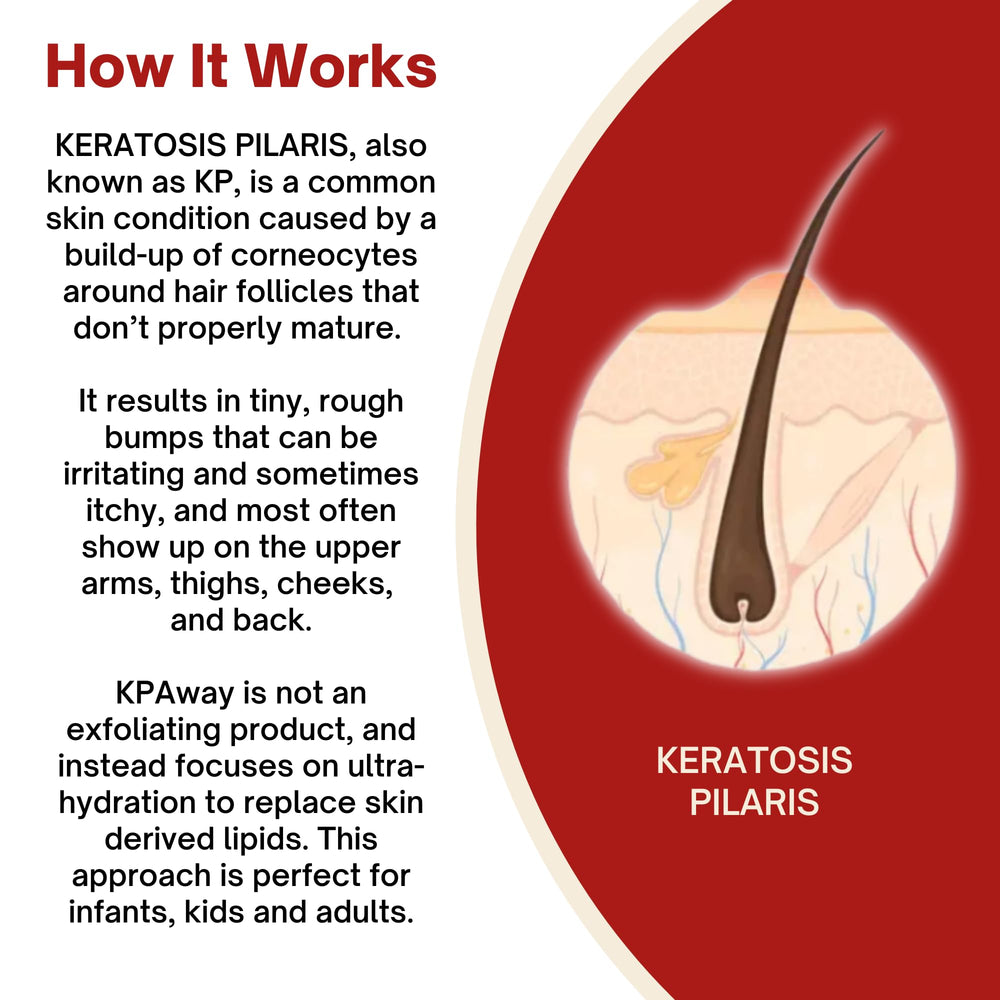 KPAWAY Kids KP cream on leg demonstrates easy daily nourishment.
