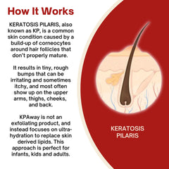 KPAWAY Kids KP cream on leg demonstrates easy daily nourishment.