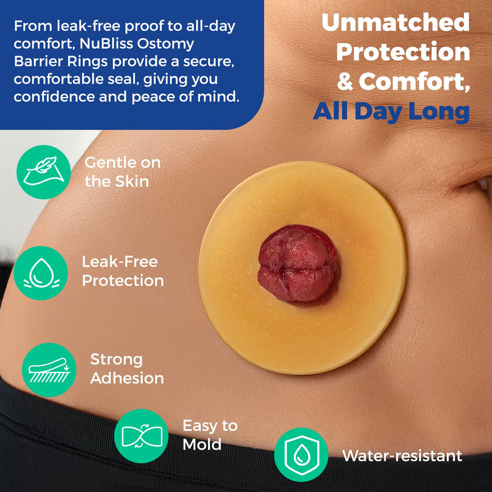 NuBliss barrier ring molded around stoma for a custom seal
