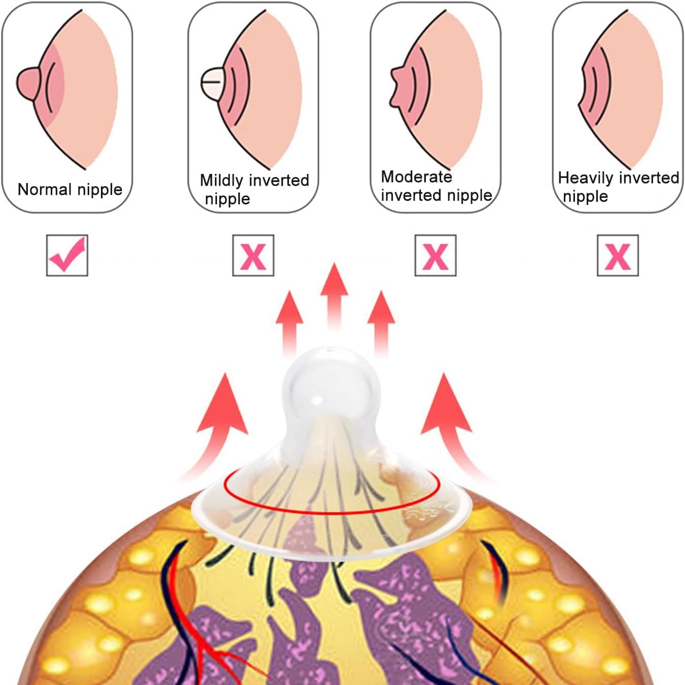 QLJMY compact nipple-corrector fits under clothing for discreet wear