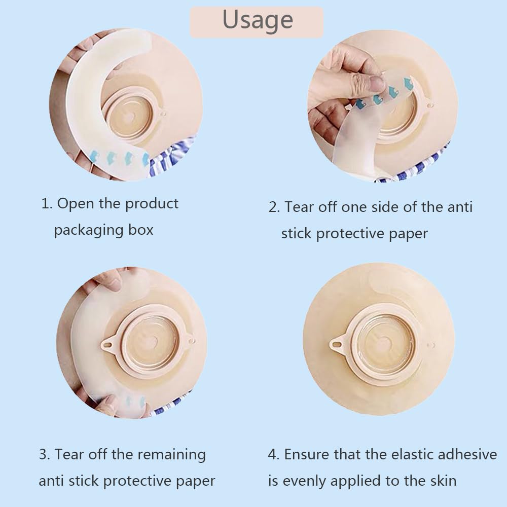 Shanzhinan barrier strip placed around the stoma enhances seal and stability.