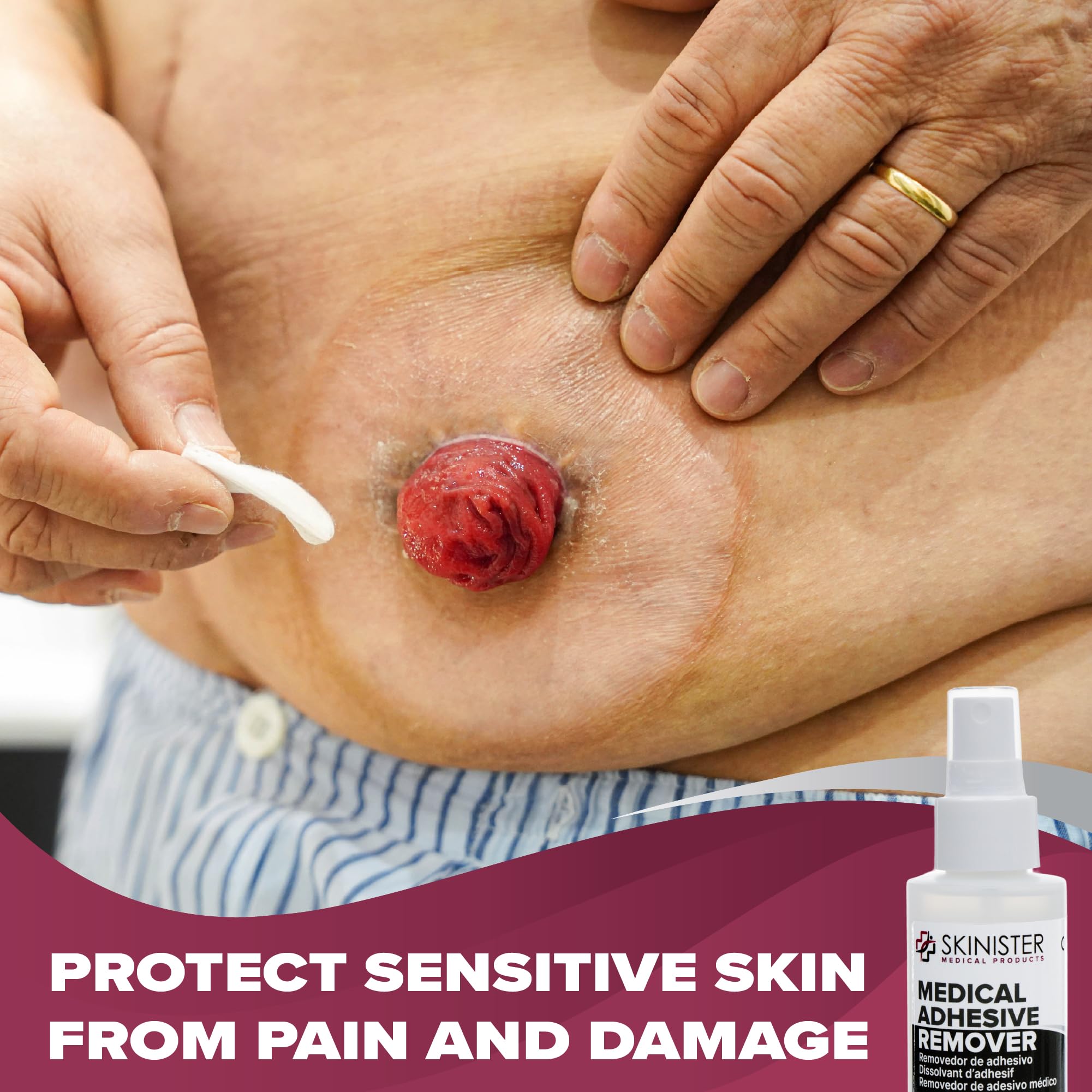 Skinister Ostomy Adhesive Remover near stoma area for gentle removal