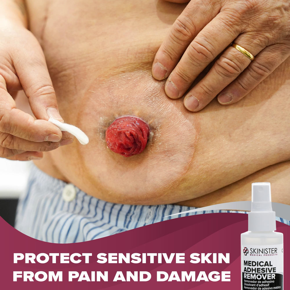 Skinister Ostomy Adhesive Remover near stoma area for gentle removal