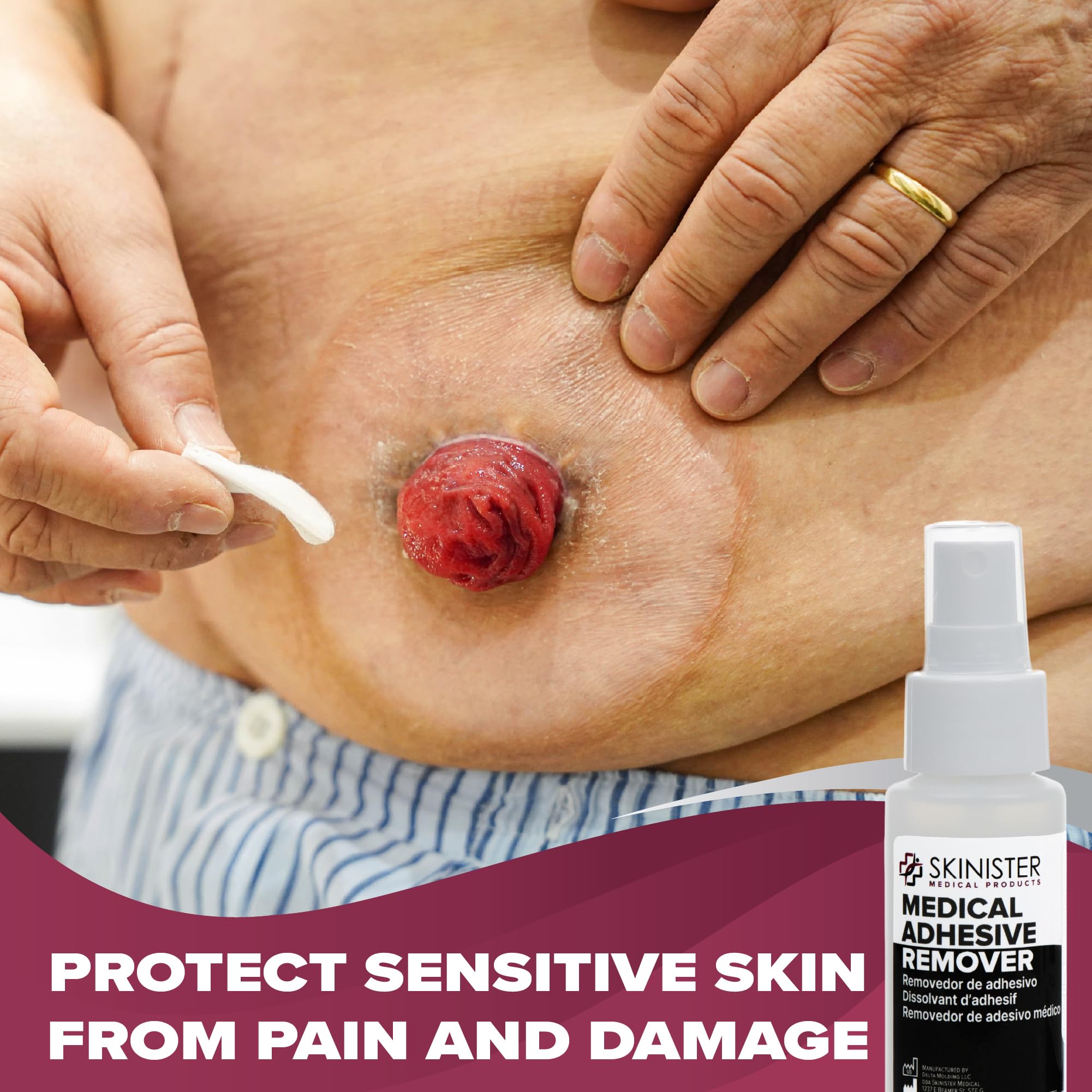 Skinister sting-free adhesive remover provides smooth removal without irritation.