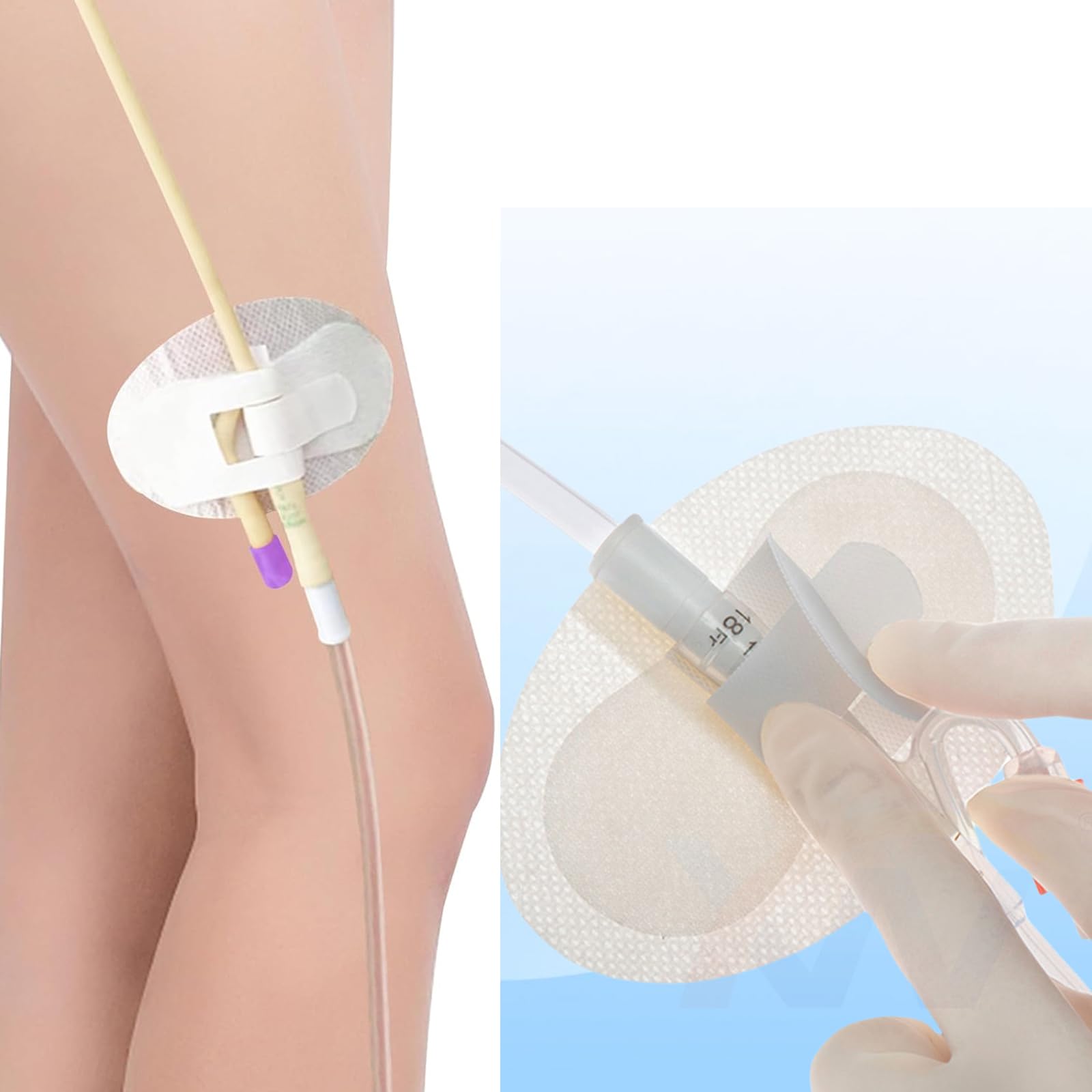 Supkeyer multi-tube stability supports ureter, PEG, and G/J tubes