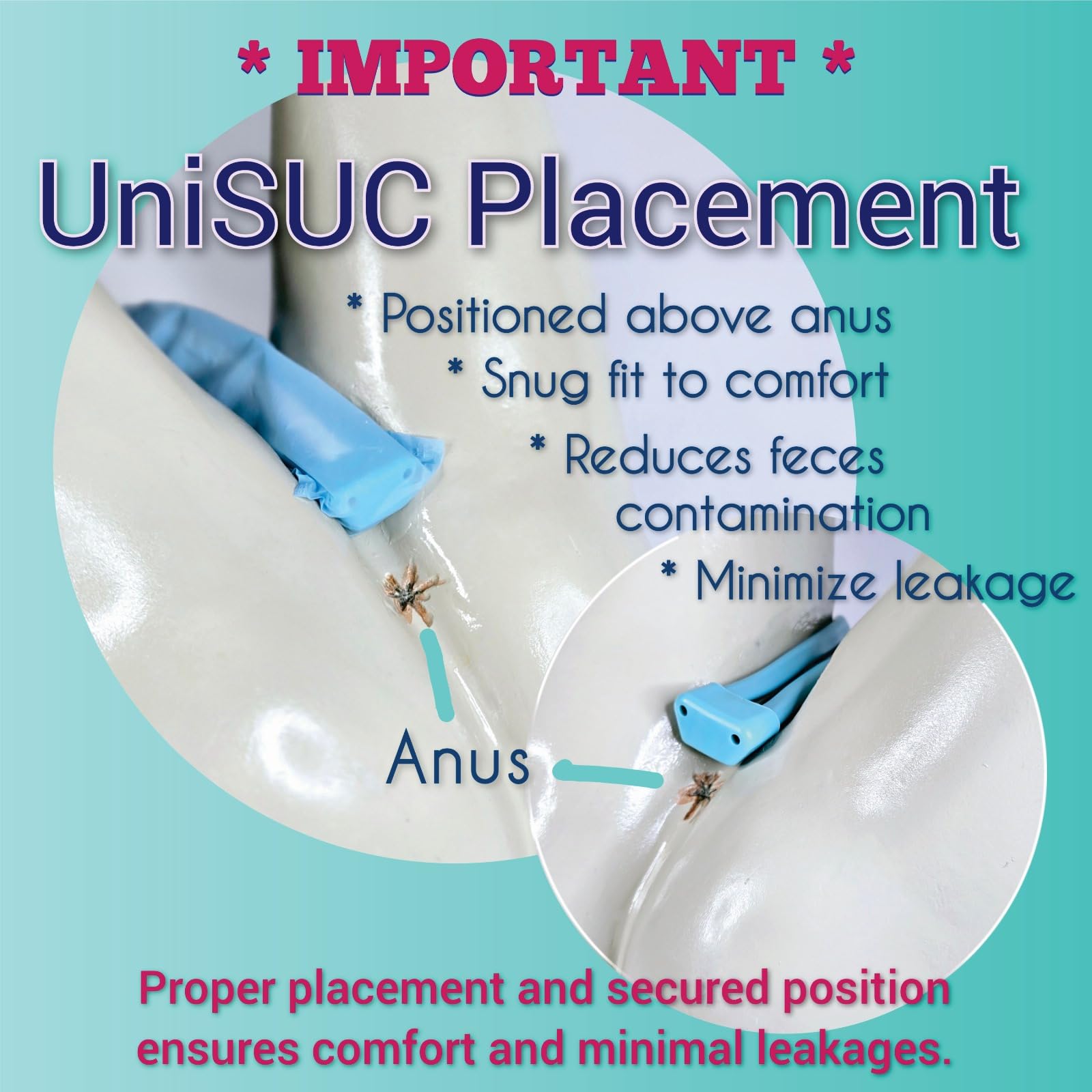 UniSUC external catheter frame reusable for cost-effective, secure incontinence care