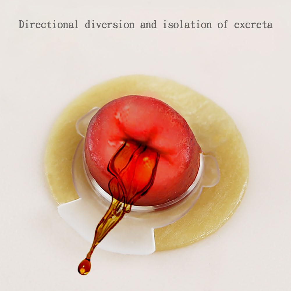 YEYSXSY ostomy barrier ring demonstrates directional flow guide in use.