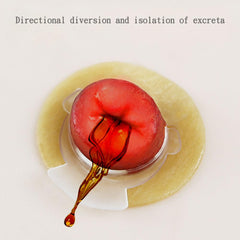 YEYSXSY ostomy barrier ring demonstrates directional flow guide in use.